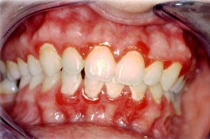 gengivite dente dentista florianopolis arte sorriso marcio cercato clareamente