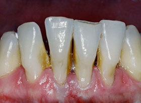 tartaro dentista florianopolis marcio certcato arte sorriso