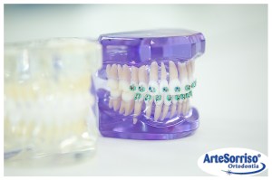 aparelho dentario marcio cercato dentista florianopolis dentes aparelho ortodontico