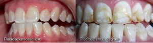 fluorose marcio cercato arte sorriso dentista florianopolis clareamento dentista