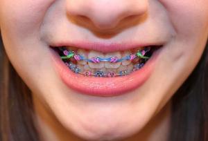 ortodontia marcio cercato arte sorriso dentista florianopolis