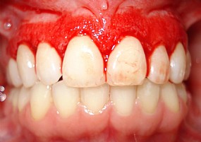 sangramento gengiva marcio cercato arte sorriso dentista florianopolis