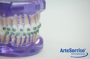 aparelho dentes ingleses dentista