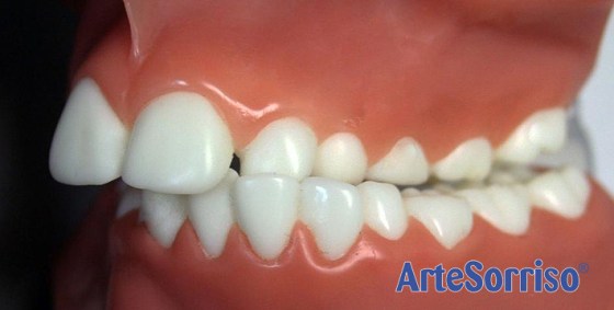 mordida-cruzada dentista