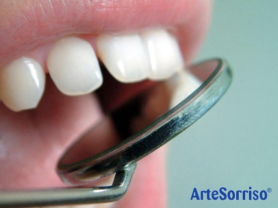 dentes separados na frente arte sorriso florianopolis ingleses