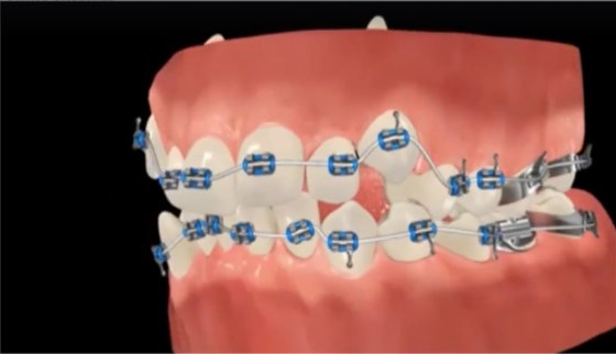 aparelho ortodontico dentes dentista florianopolis ingleses