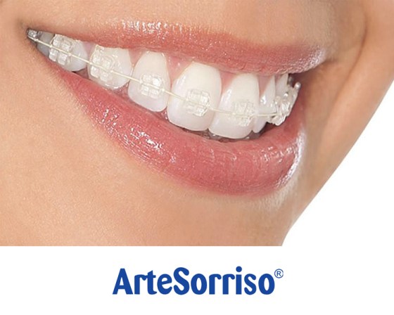 dentista aparelho transparente ingleses florianopolis arte sorriso