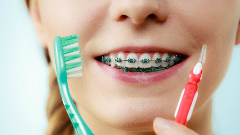dentista ingleses aparelho ortodontico limpeza