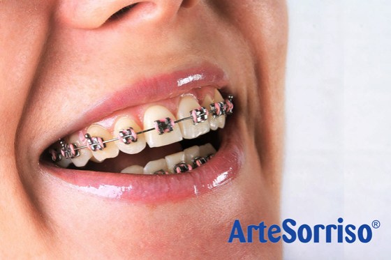 aparelho dentes dentista ingleses floripa.jpg