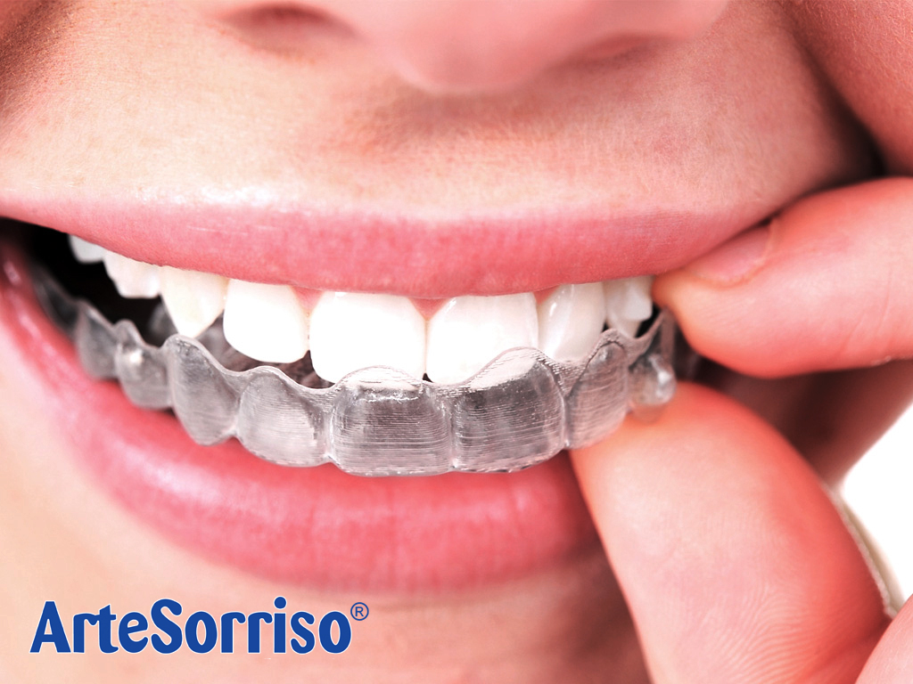 aparelho invisível arte sorriso dentista ingleses