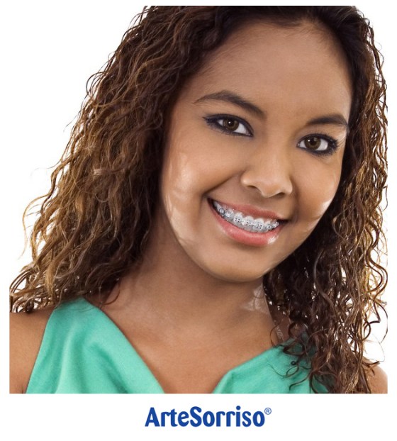 beneficios aparelho ortodontico dentista ingleses arte sorriso